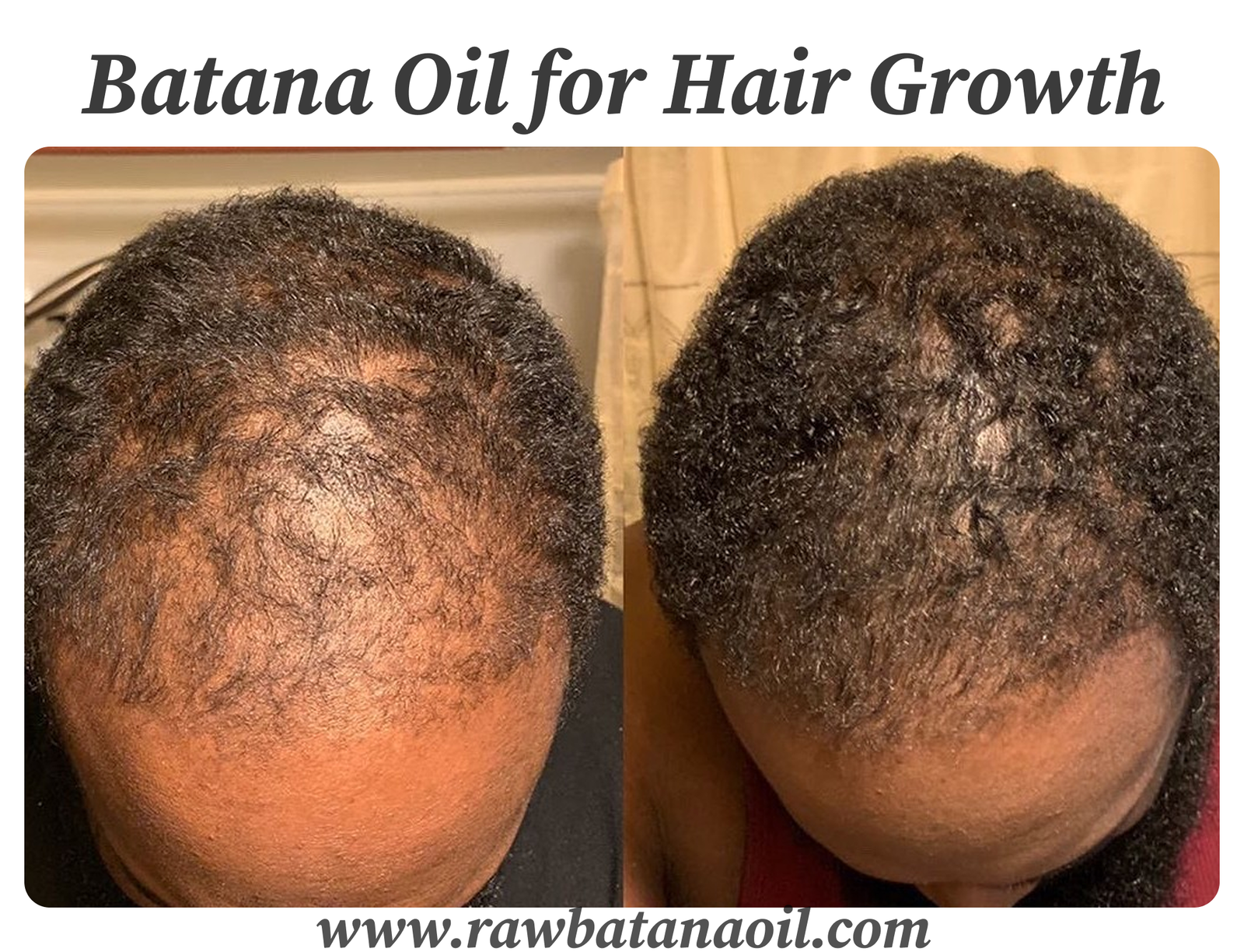 Batana Oil for Hair Growth