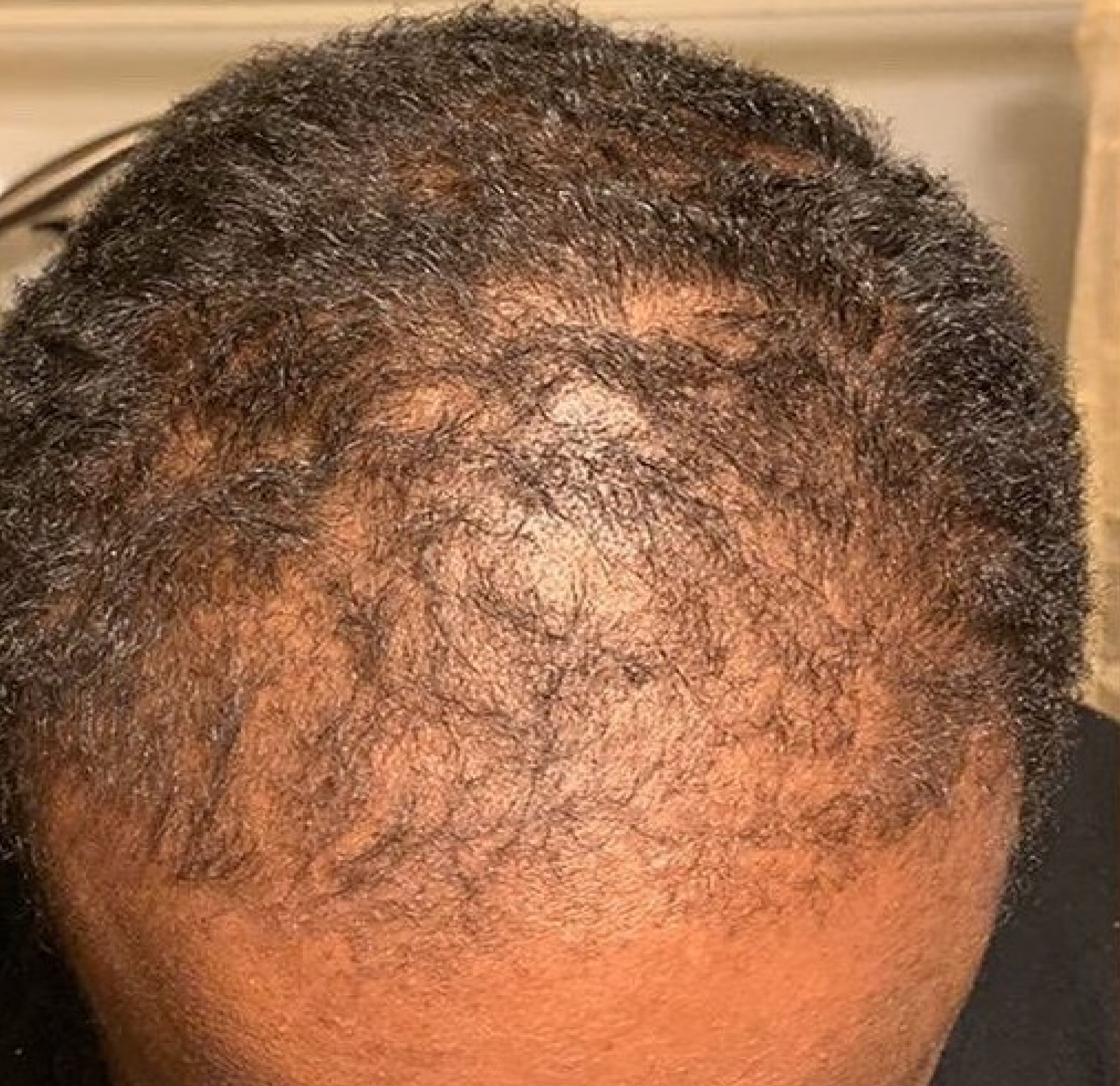 Batana oil result before and after