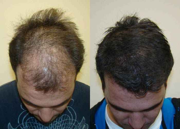 Batana Oil for Hair Shedding