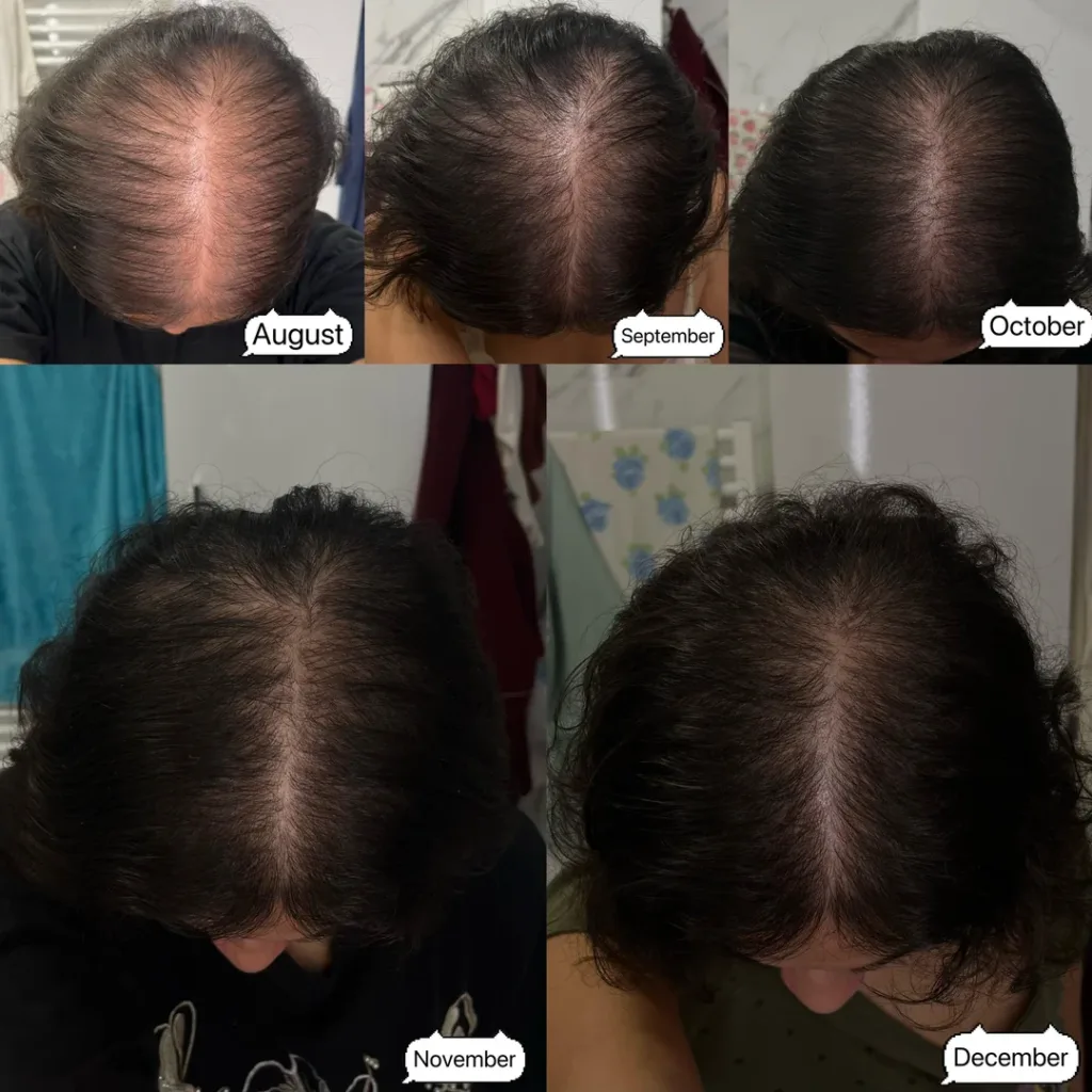 Batana Oil for Receding Hairline