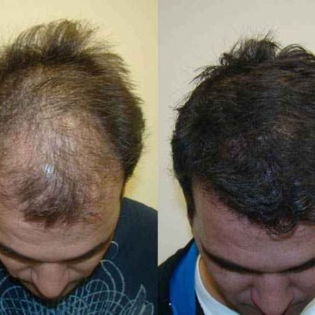 Batana Oil for Hair Shedding
